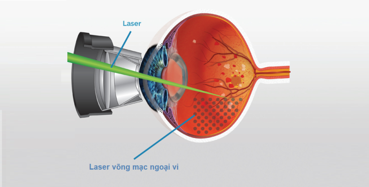 laser-quang-dong-vong-mac